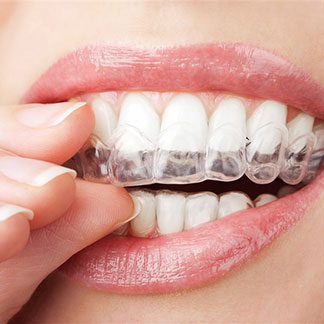 invisalign faqs